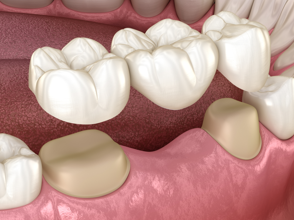 Dental Bridge Treatment in Rogers, Arkansas
